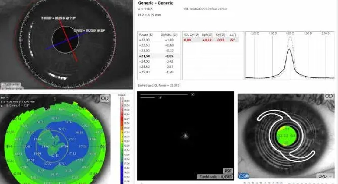 Еволюція та розвиток хірургії катаракти: платформа MS39-OSIRIS CSO